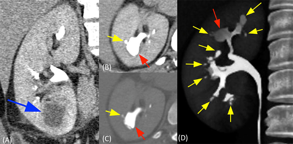 Renal Abscess and Papillary Necrosis